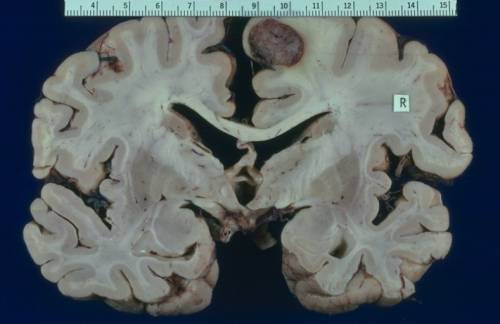 Medulloblastoma, la fenformina può contrastarlo